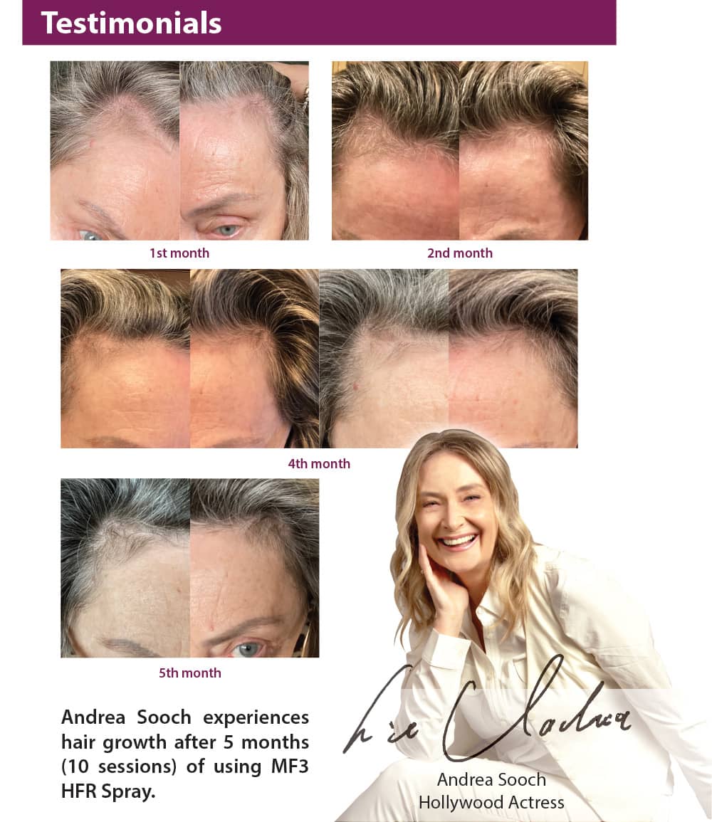 Andrea Sooch experiences hair growth after 5 months (10 sessions) of using MF3 HFR Spray.